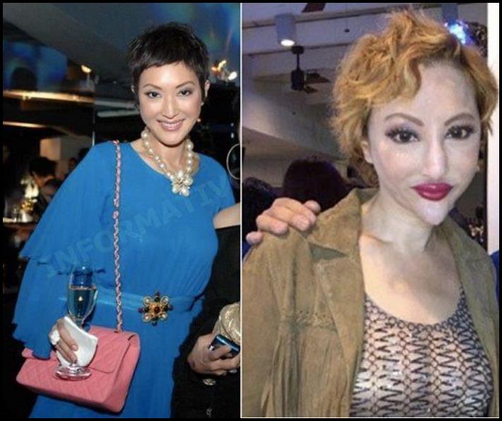 14 մարդ պլաստիկ վիրահատությունից հետո, որոնց ավելի լավ է չնայել