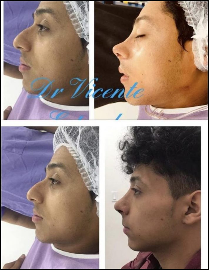 14 մարդ պլաստիկ վիրահատությունից հետո, որոնց ավելի լավ է չնայել