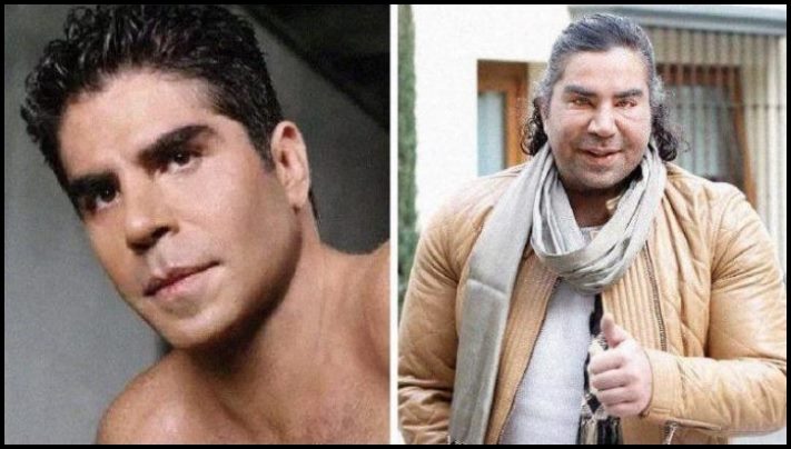 14 մարդ պլաստիկ վիրահատությունից հետո, որոնց ավելի լավ է չնայել