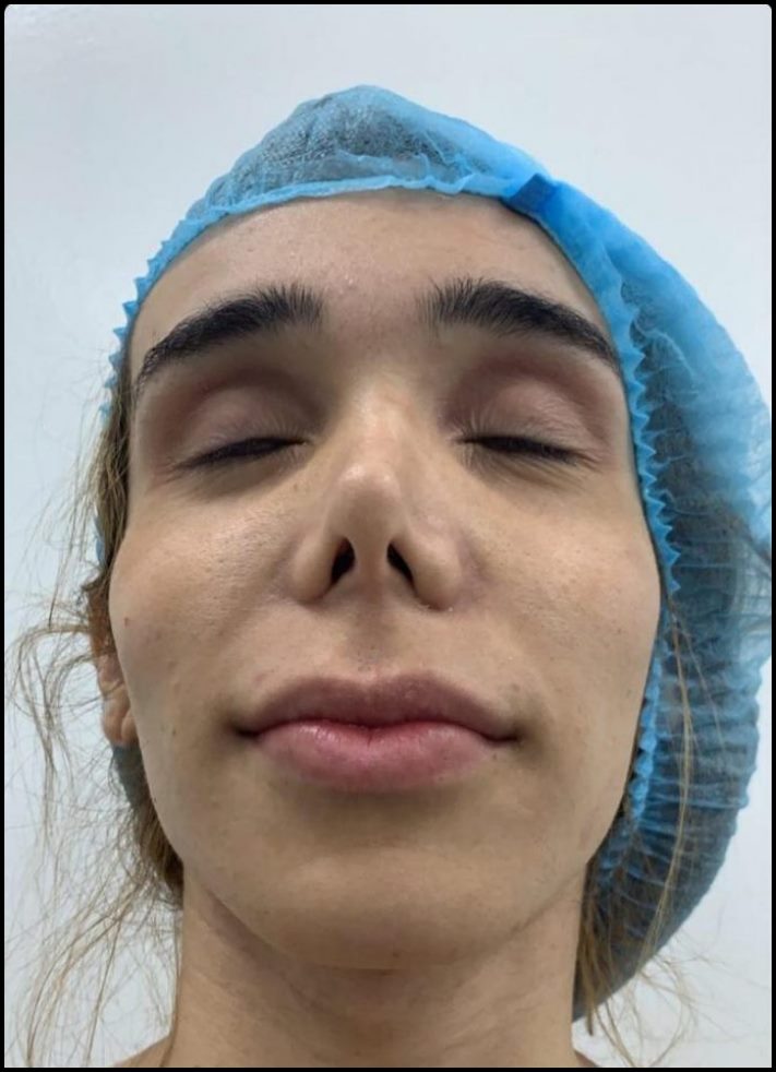 14 մարդ պլաստիկ վիրահատությունից հետո, որոնց ավելի լավ է չնայել