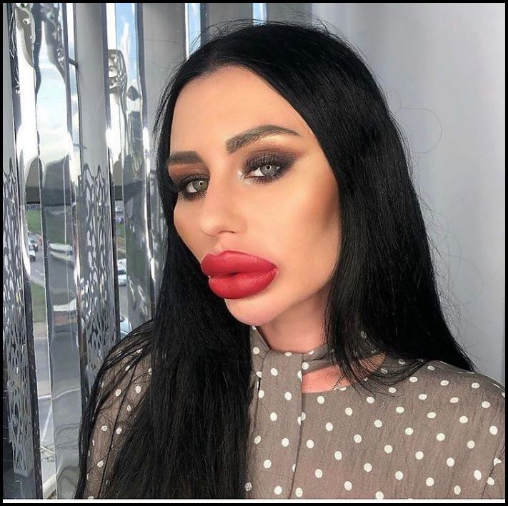 Դեմքի կեսը փչել են: 10 աղջիկ, ովքեր չափը շատ անցան՝ շրթունքների մեծացման հարցում