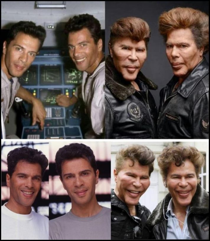 14 մարդ պլաստիկ վիրահատությունից հետո, որոնց ավելի լավ է չնայել