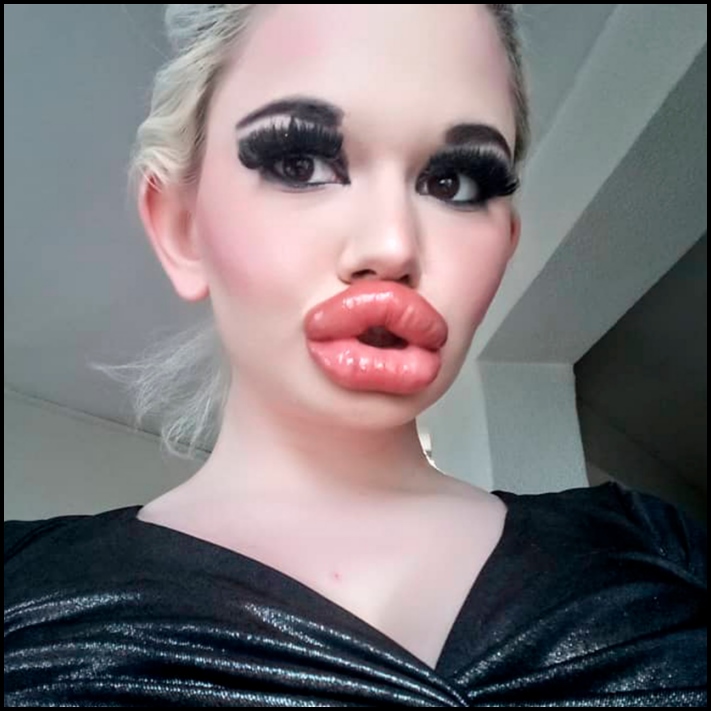 Դեմքի կեսը փչել են: 10 աղջիկ, ովքեր չափը շատ անցան՝ շրթունքների մեծացման հարցում