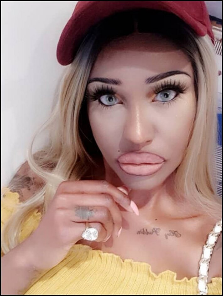 Դեմքի կեսը փչել են: 10 աղջիկ, ովքեր չափը շատ անցան՝ շրթունքների մեծացման հարցում