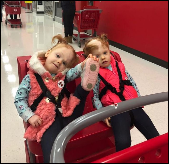 Երեք տարի առաջ բժիշկները բաժանեցին սիամական մեկ տարեկան երկվորյակներին: Ինչպե՞ս են այժմ ապրում նորածինները