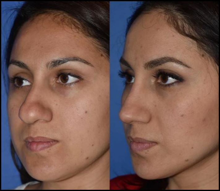 «Արծվաքթեր և կարտոֆիլ-քթեր»․ ինչպես է փոխվում աղջիկների դեմքը քթի վիրահատությունից հետո