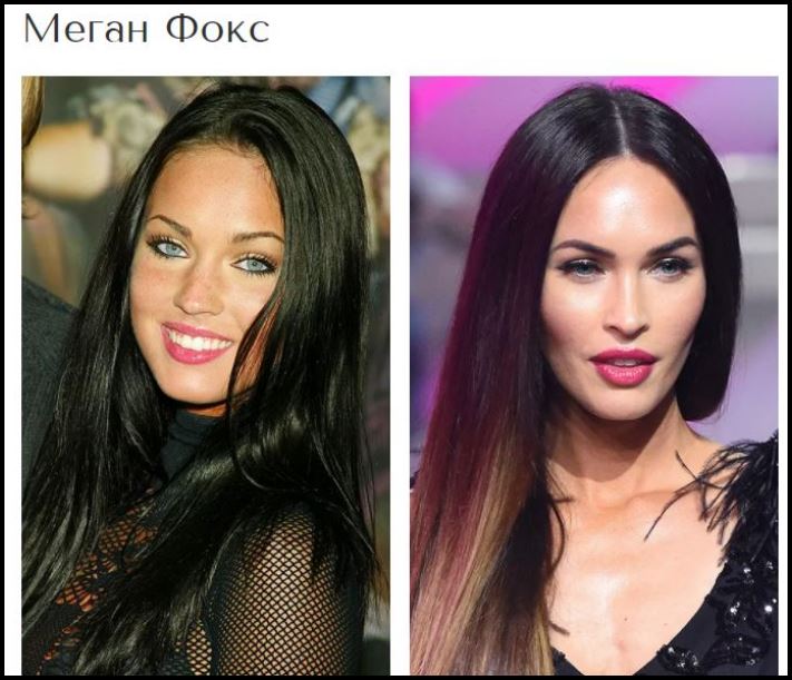 Շնորհակալությո՛ւն, բժիշկ: Պլաստիկ վիրահատություններից հետո հաջողության հասած 8 աստղեր