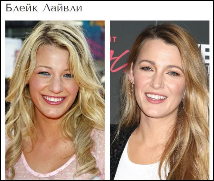 Շնորհակալությո՛ւն, բժիշկ: Պլաստիկ վիրահատություններից հետո հաջողության հասած 8 աստղեր