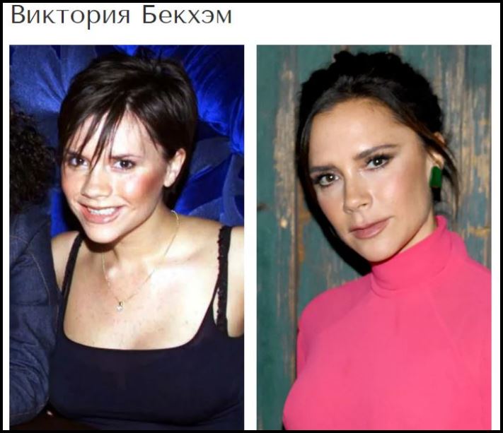 Շնորհակալությո՛ւն, բժիշկ: Պլաստիկ վիրահատություններից հետո հաջողության հասած 8 աստղեր