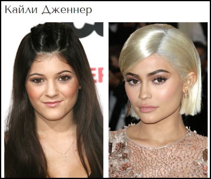 Շնորհակալությո՛ւն, բժիշկ: Պլաստիկ վիրահատություններից հետո հաջողության հասած 8 աստղեր