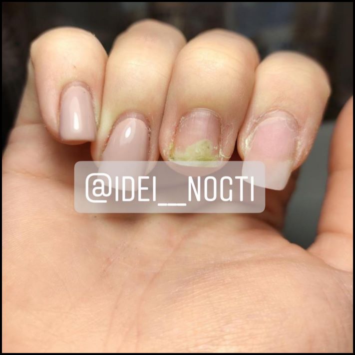 Այսպես մի արեք։ Եղունգների 10 օրինակ, որոնց նայելը նույնիսկ տհաճ է