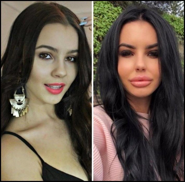 Առաջ և հետո։ Աղջիկներ, ովքեր պլաստիկ վիրահատությամբ փչացրել են իրենց դեմքն ու շուրթերը