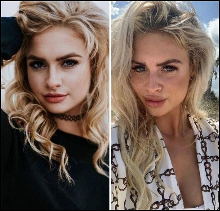 Առաջ և հետո։ Աղջիկներ, ովքեր պլաստիկ վիրահատությամբ փչացրել են իրենց դեմքն ու շուրթերը