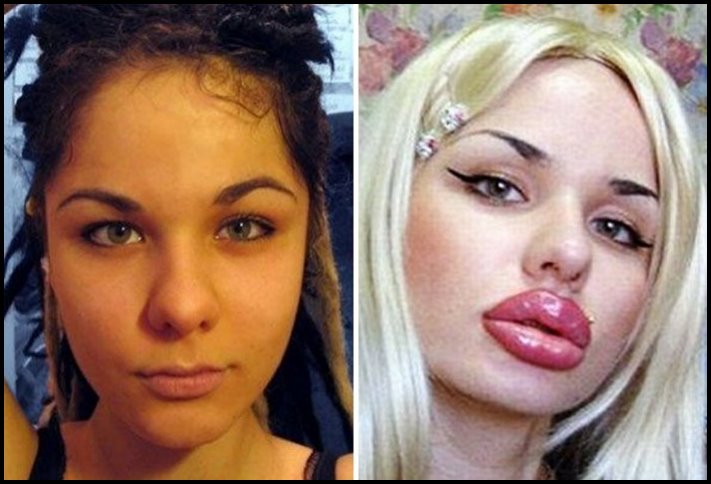 Առաջ և հետո։ Աղջիկներ, ովքեր պլաստիկ վիրահատությամբ փչացրել են իրենց դեմքն ու շուրթերը