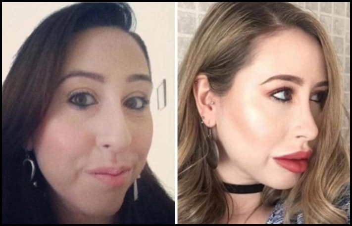 Առաջ և հետո։ Աղջիկներ, ովքեր պլաստիկ վիրահատությամբ փչացրել են իրենց դեմքն ու շուրթերը