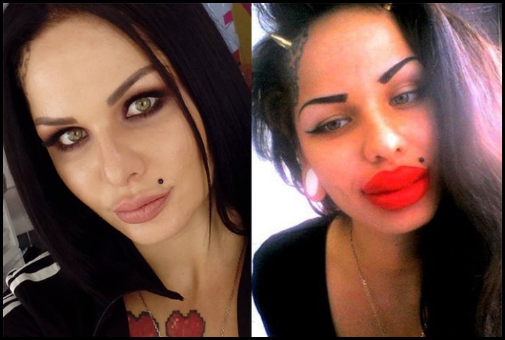 Առաջ և հետո։ Աղջիկներ, ովքեր պլաստիկ վիրահատությամբ փչացրել են իրենց դեմքն ու շուրթերը