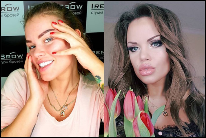 Առաջ և հետո։ Աղջիկներ, ովքեր պլաստիկ վիրահատությամբ փչացրել են իրենց դեմքն ու շուրթերը