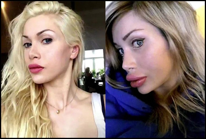 Առաջ և հետո։ Աղջիկներ, ովքեր պլաստիկ վիրահատությամբ փչացրել են իրենց դեմքն ու շուրթերը