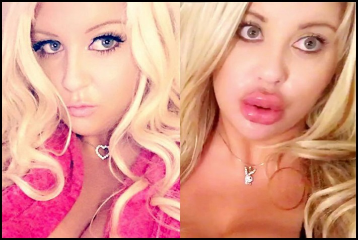 Առաջ և հետո։ Աղջիկներ, ովքեր պլաստիկ վիրահատությամբ փչացրել են իրենց դեմքն ու շուրթերը