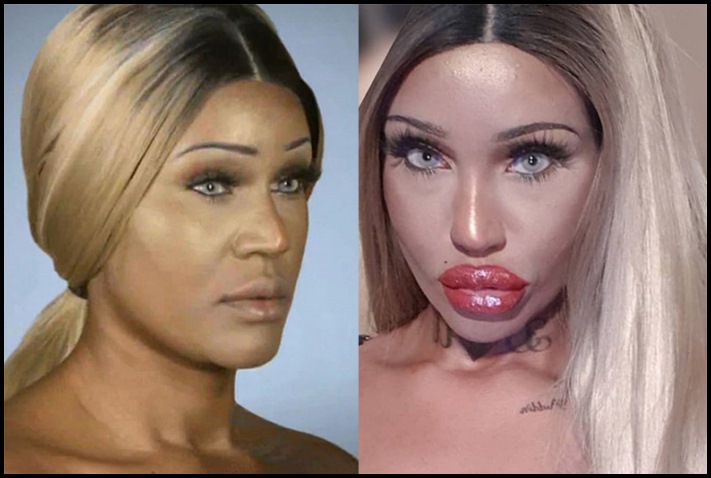 Առաջ և հետո։ Աղջիկներ, ովքեր պլաստիկ վիրահատությամբ փչացրել են իրենց դեմքն ու շուրթերը