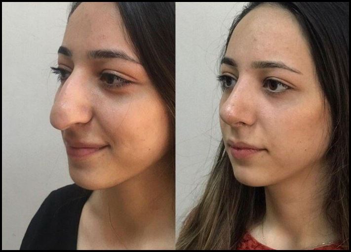 Համացանցի հասարակ աղջիկների լուսանկարներ, որոնք ակնհայտորեն շահել են պլաստիկ վիրահատությունից