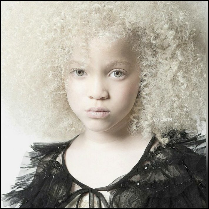 Անսովոր մարդկանց 19 օրինակ, ովքեր նման տեսք են ստացել գենետիկ մուտացիաների պատճառով