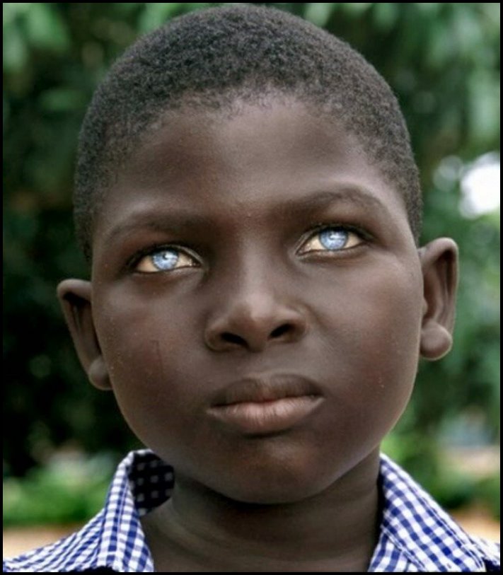 Անսովոր մարդկանց 19 օրինակ, ովքեր նման տեսք են ստացել գենետիկ մուտացիաների պատճառով