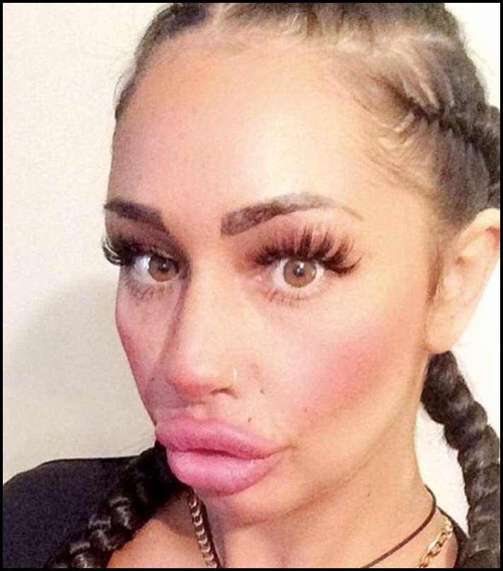 8 գեղեցկուհիներ, ովքեր չափն անցել են շուրթերի մեծացման հարցում