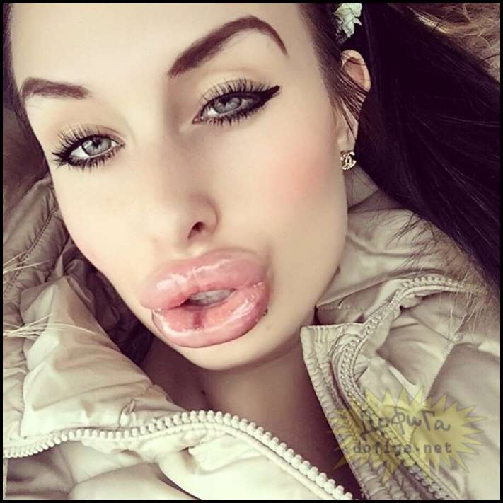 8 գեղեցկուհիներ, ովքեր չափն անցել են շուրթերի մեծացման հարցում