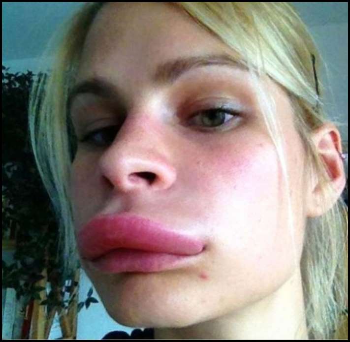 8 գեղեցկուհիներ, ովքեր չափն անցել են շուրթերի մեծացման հարցում