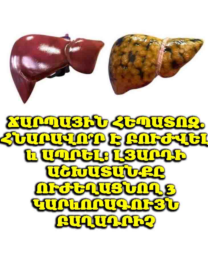 🛑 Ճարպային հեպատոզ. հնարավո՞ր է բուժվել և ապրել։ Լյարդի աշխատանքը ուժեղացնող 3 կարևորագույն բաղադրիչ