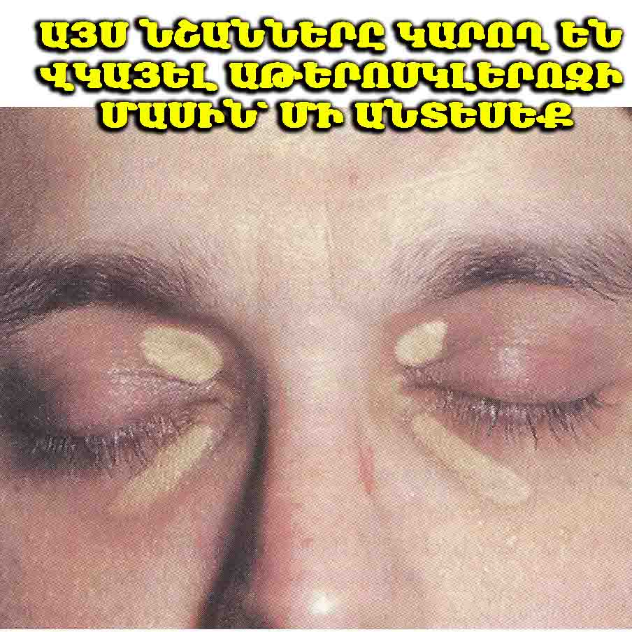 ⚠️ Աթերոսկլերոզը կարող է ունենալ տեսանելի արտահայտված նշաններ, որոնք անվանում են «ստիգմներ»