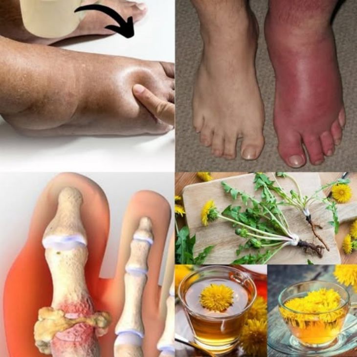 🦶 Ոտքերի ու կրունկների այտուցվածությունն այն խնդիրներից է, որի հետ բախվում են շատերը