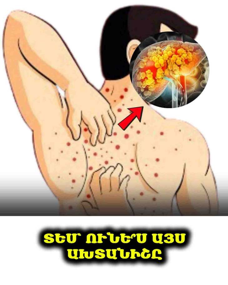 ⚠️ Ճարպակալած լյարդ․ պատճառները, ախտանիշները, բուժման եղանակներն ու բնական տնային միջոցները