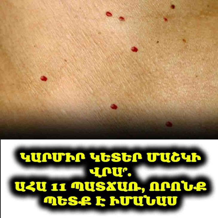 🔴 11 պատճառ, թե ինչու մաշկի վրա հայտնվում են կարմիր կետեր