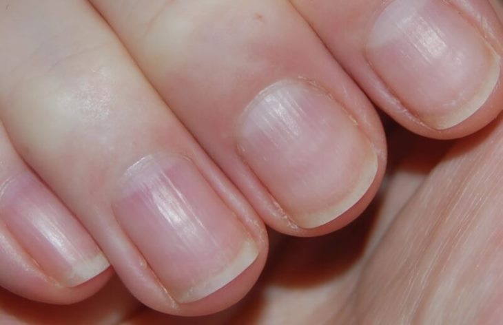 💅 Ի՞նչ են իրականում նշանակում եղունգների վրա գտնվող ուղղահայաց գծերը․ ճշմարտությունը ձեզ շատ կզարմացնի