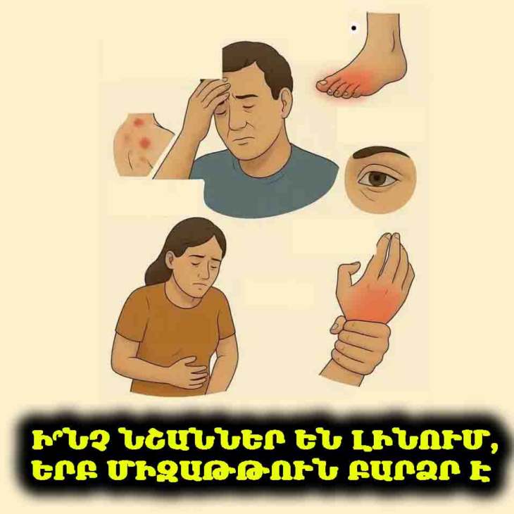 ⚠️ Ի՞նչ նշաններ են լինում, երբ միզաթթուն բարձր է