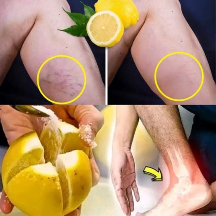 Մայրիկի բնական դեղատոմսը 🍋 կիտրոնով. ոտքերի ցավի 🦵, ռևմատիզմի, վարիկոզի, արթրիտի, գլխացավերի 🤕 և հոդացավերի դեմ