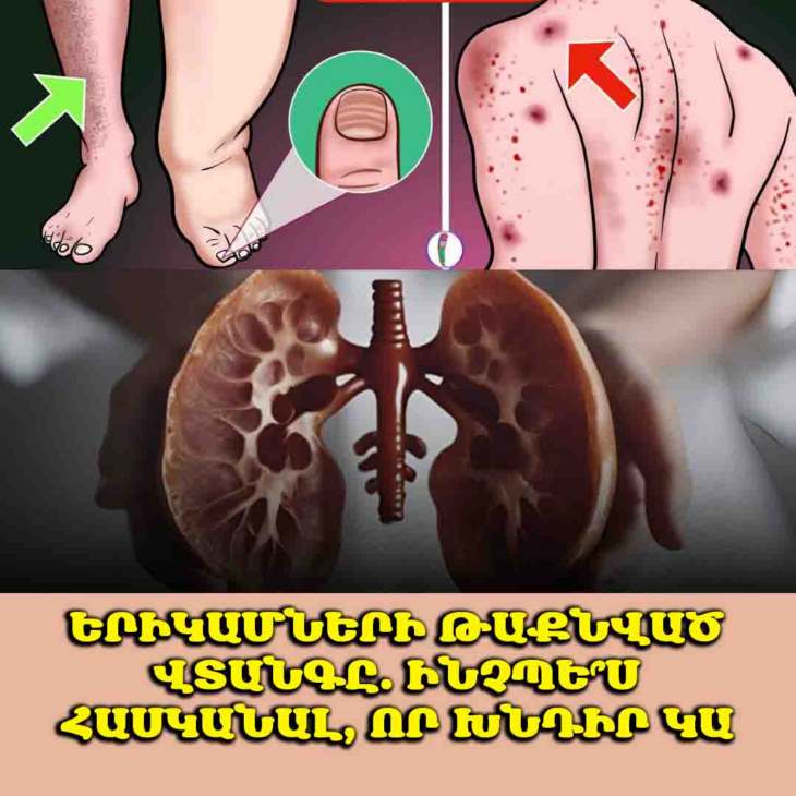 🚨 10 նախազգուշացնող նշան, որ ձեր երիկամները կարող են խնդիրներ ունենալ