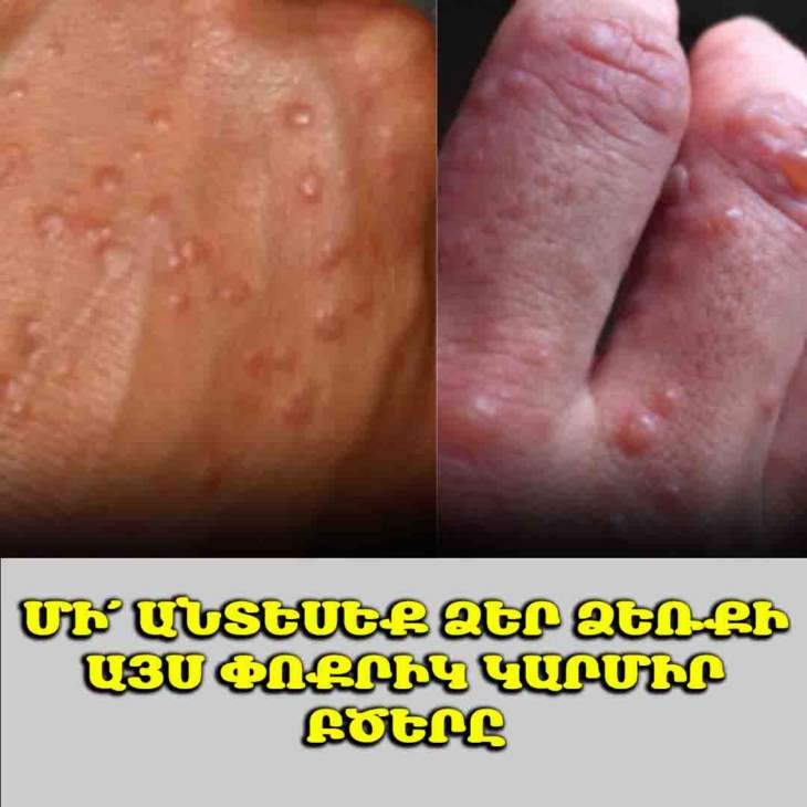 🔴 Մի՛ անտեսեք ձեր ձեռքի այս փոքրիկ կարմիր բծերը․ Դրանք կարող են լուրջ նախազգուշացնող նշաններ լինել