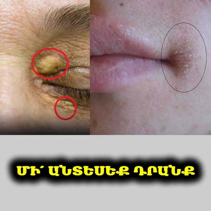 👁️ Դեմքի 4 նշան, որոնք կարող են վկայել առողջական խնդիրների մասին