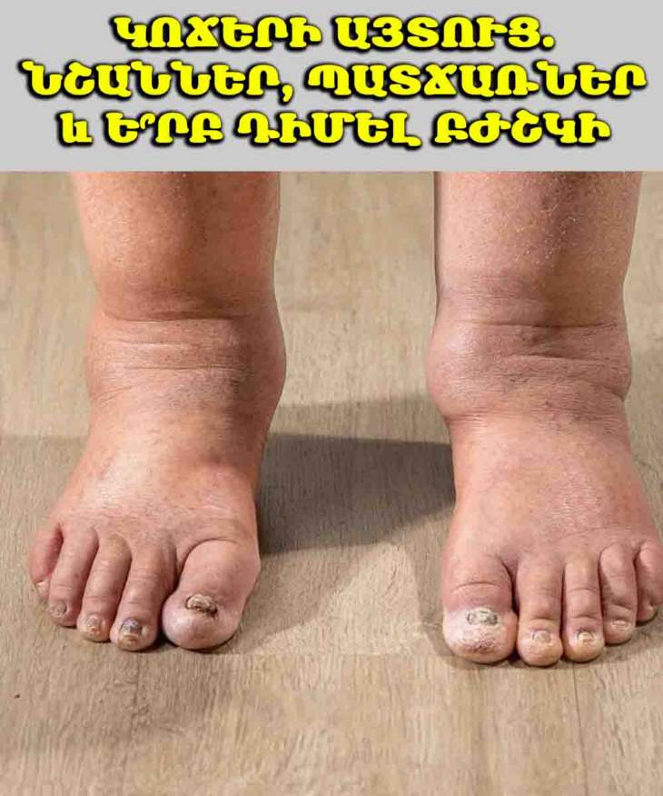 👣 Երեկոյան կոճերն ուռչու՞մ են. Մի՛ անտեսեք։ Սա կարող է լինել ձեր մարմնի նախազգուշացումը։ Իմացե՛ք, թե ինչու։