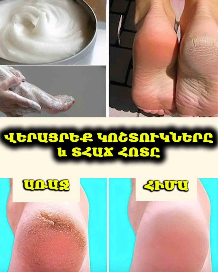 💖 Դադարե՛ք թաքցնել ձեր ոտքերը։ Բացահայտեք, թե ինչպես կարող եք տանը կատարյալ պեդիկյուր անել ընդամենը մի քանի դրամով՝ սոդայի միջոցով։ Ոտքերի փայլուն գաղտնիքը։
