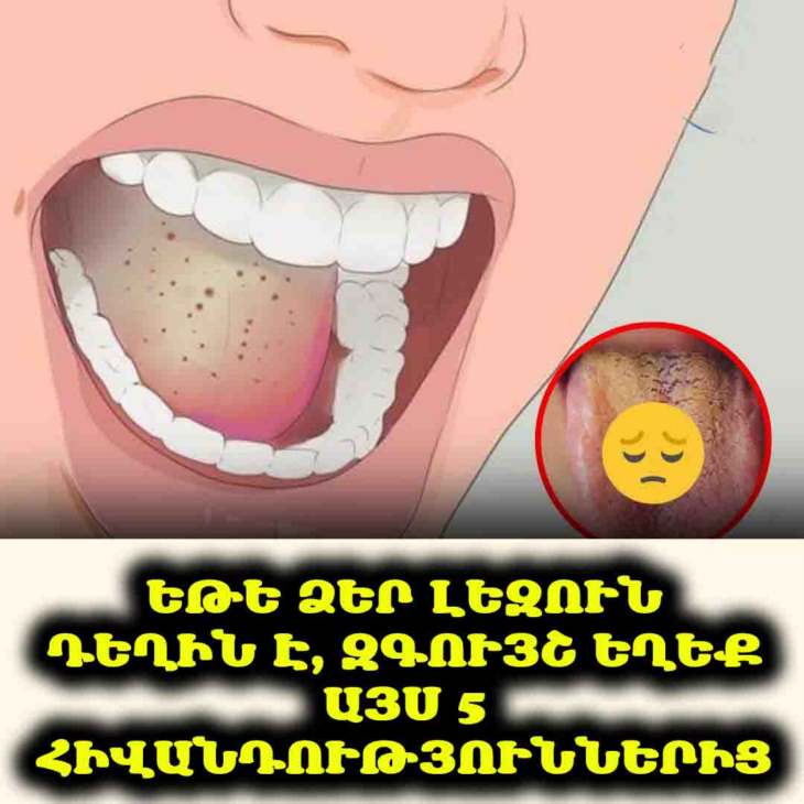 👅 Լեզուն դեղի՞ն է. Զգուշացե՛ք այս 5 հիվանդություններից։
