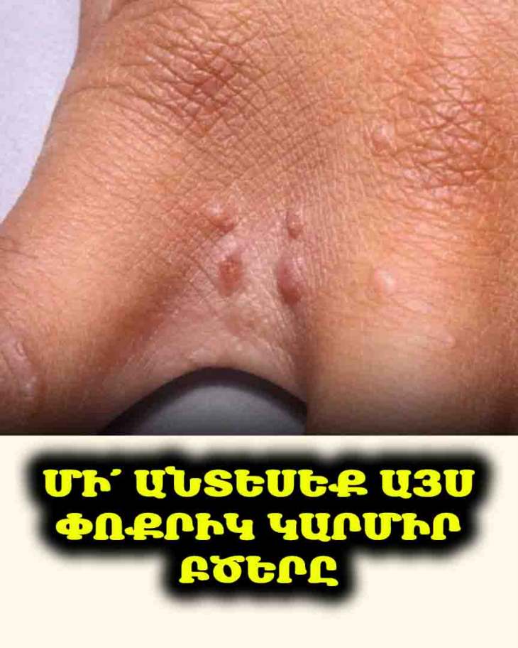 🔴 Մի՛ անտեսեք ձեռքի կարմիր բծերը. Դրանք կարող են քոսի նշան լինել