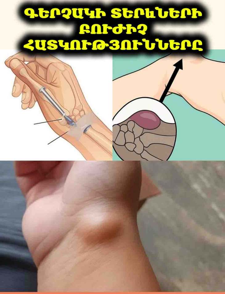 🌿 Գերչակի տերևներ. Բուժիչ ուժը և անվտանգության կարևորագույն խորհուրդները