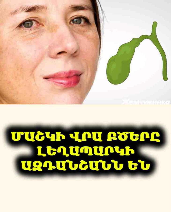 🌞 Մաշկի պիգմենտացիա. Ի՞նչ է ազդարարում լեղապարկը և ինչպես ազատվել բծերից: