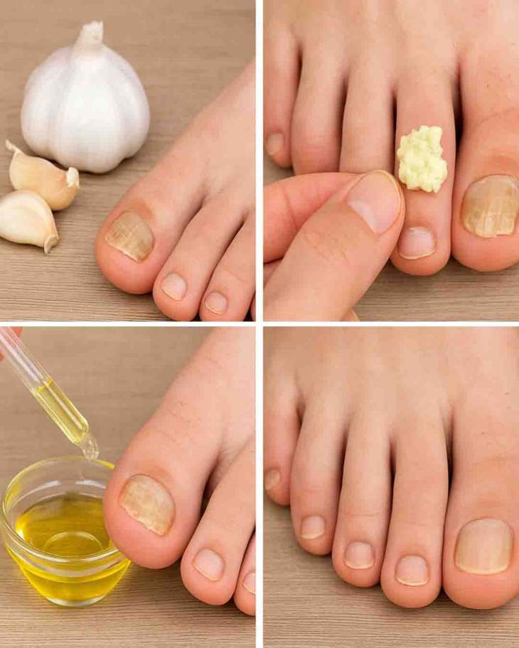 🧄 Ասա՛ «Ցտեսություն» Եղունգի Սնկին Սխտորի Միջոցով. Բնական Լուծում