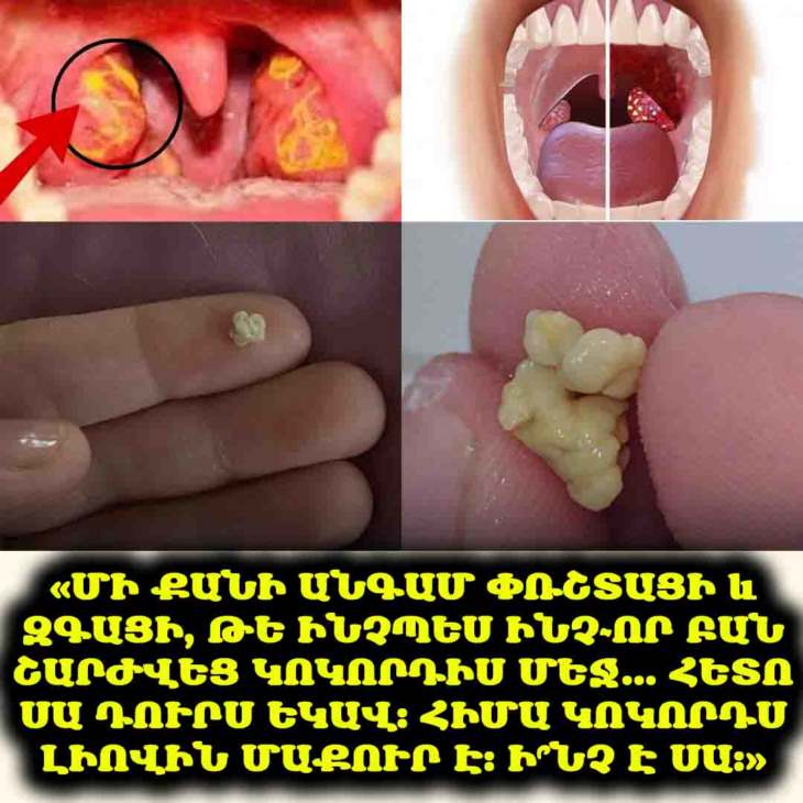 🤢 Բերանից տհաճ հոտի պատճառը կարող է լինել անսպասելի։ Բացահայտեք, թե ինչպես են նշագեղձերի քարերը ազդում ձեր շնչառության վրա։