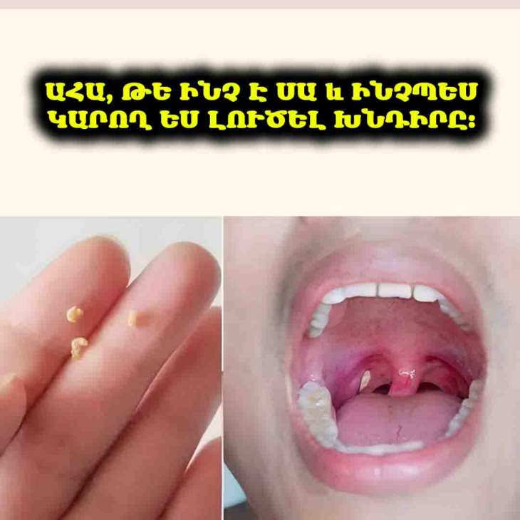 🤮 Հրաժեշտ տհաճ բերանի հոտին։ Իմացեք, թե ինչպես ազատվել դրանից ընդմիշտ։